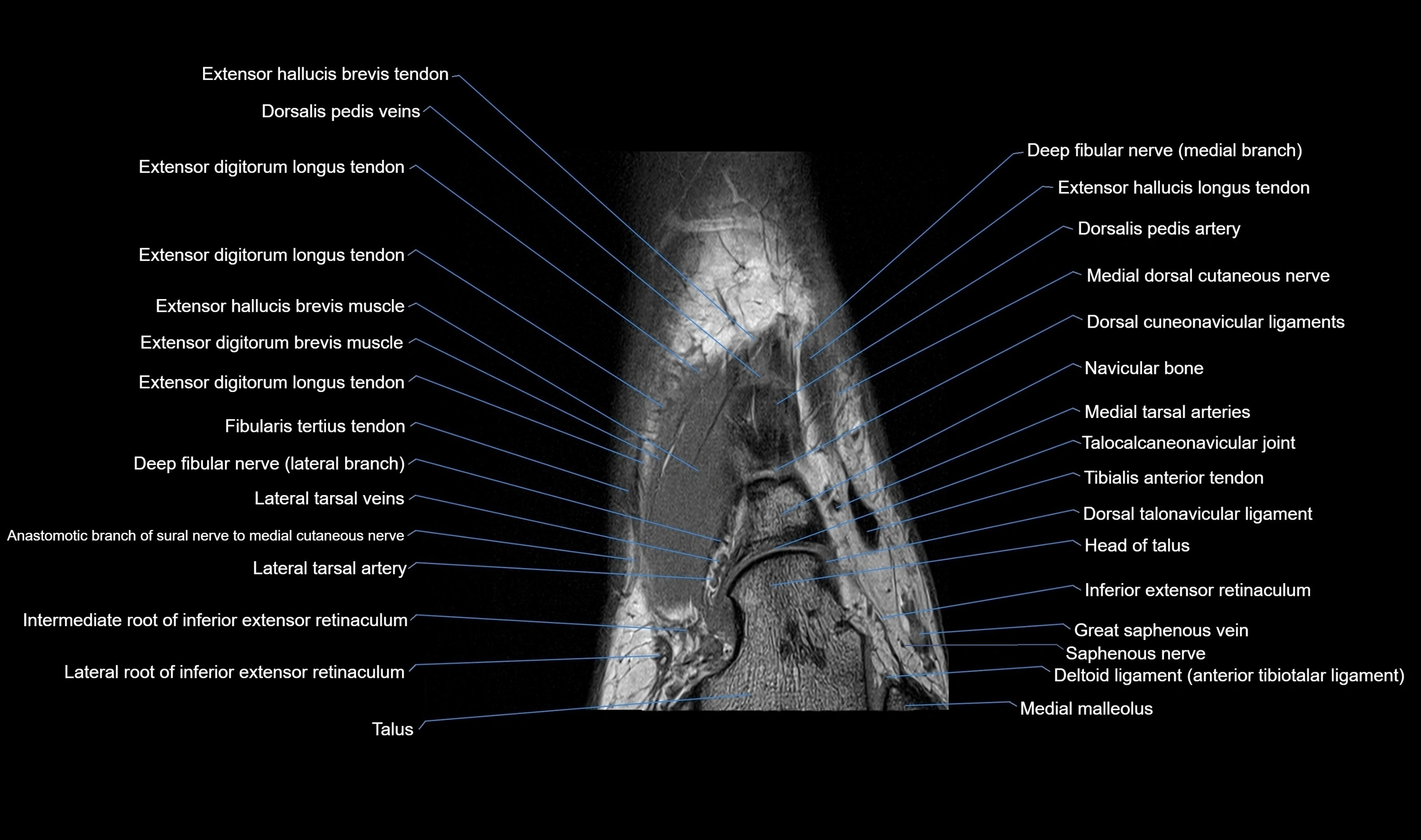 MRI mid foot coronal ligaments cross sectional anatomy 3T  radiology  image-img-00001-00012.webp
